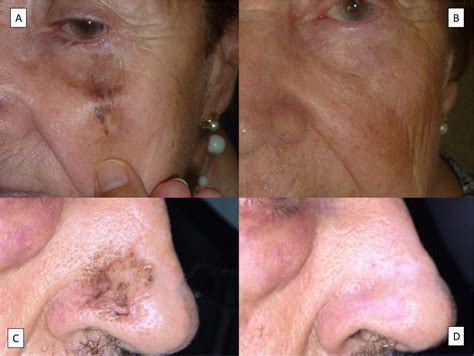 Update on Lentigo Maligna: Diagnostic Signs and Treatment | Actas Dermo
