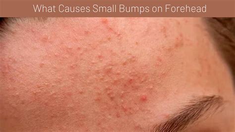 small bumps  forehead dont   mistakes  skincare web