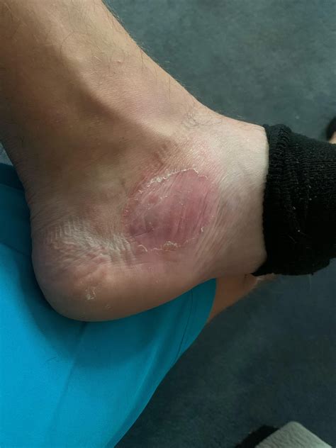 Two spots one foot : r/Dyshidrosis