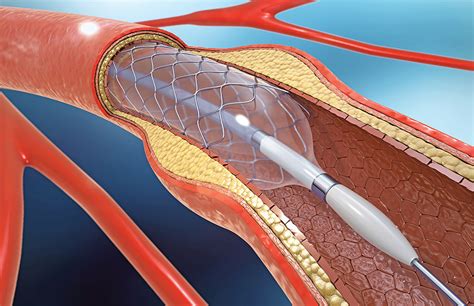 Heart Cath Procedure Anesthesia at Jo Mendes blog