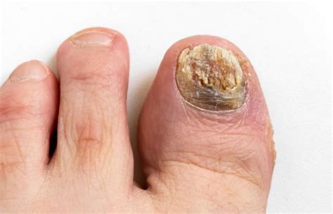 Mastering the Art of Understanding and Treating Nail Fungus | Polish ...