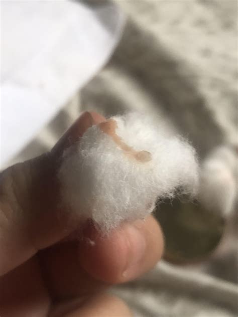 popping sebaceous cyst 6