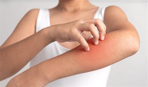 Urticaria: A Common Skin Condition Resulting In Itchy Hives - Allergy ...