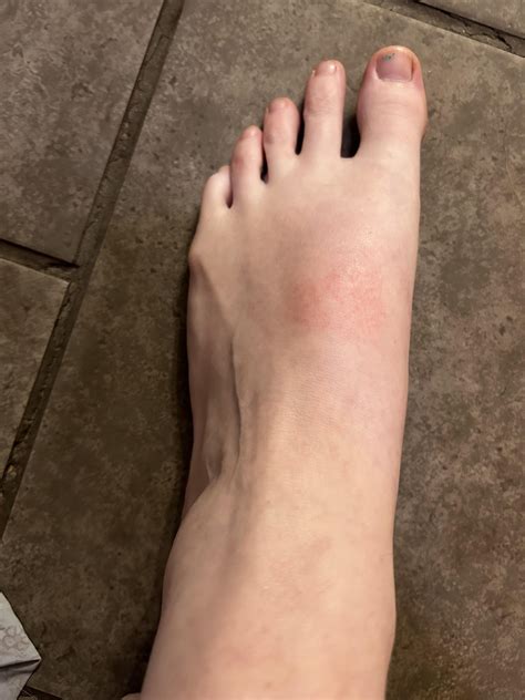 Severe foot pain + rash : r/BabyBumps