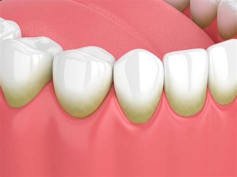 Brown Spots on Teeth (Causes, Prevention & Treatment)