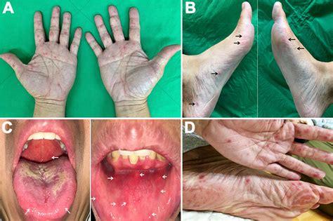What Do Hand Foot Mouth Blisters Look Like - Infoupdate.org