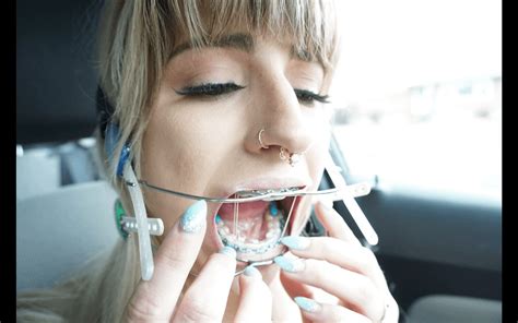 Unfortunate predicament : r/headgearbraces
