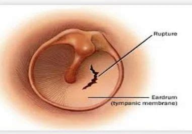 Eardrum Rupture Treatment in Vaishali Nagar, Ajmer | ID: 17464090512