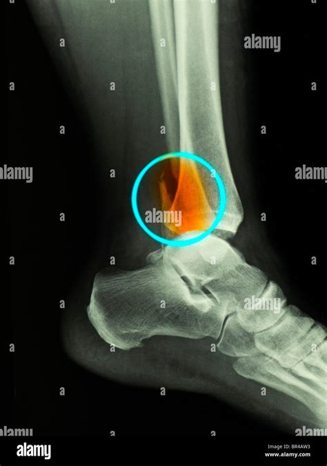 X-ray showing a bimalleolar ankle fracture in a 50 year old woman Stock ...