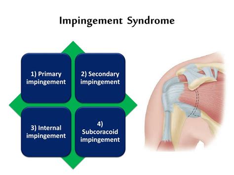 impingement syndrome powerpoint    id