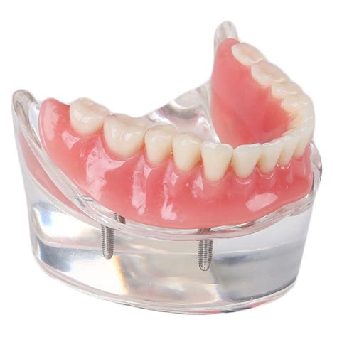 Amazon.com: SOARDAY Dental Restoration Model with 4 implants ...