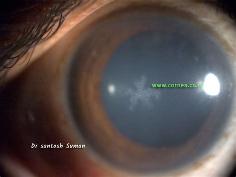 Dendrites – Cornea