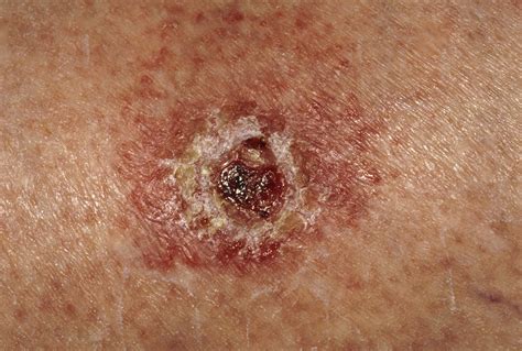 skin cancer symptoms signs types treatments prevention