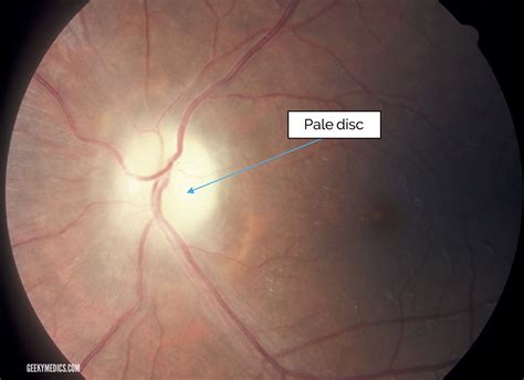 Optic Disc Pallor Causes at Valerie Robinson blog