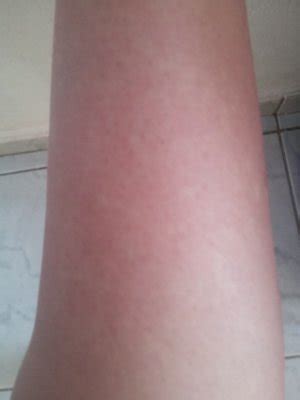 Mancha Branca Na Perna Na Gravidez - Manchas brancas nas pernas. Mas alguém? | BabyCenter