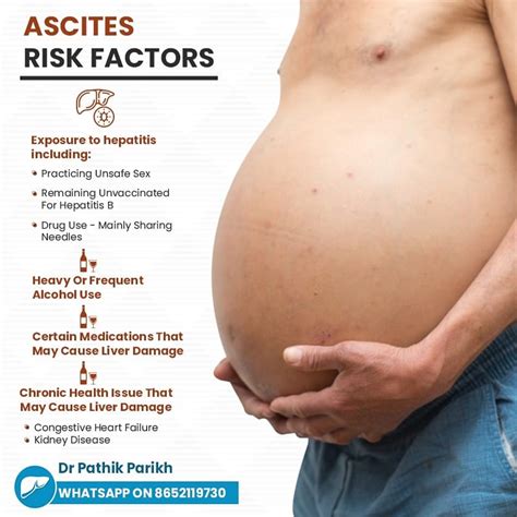 Alcoholic Ascites