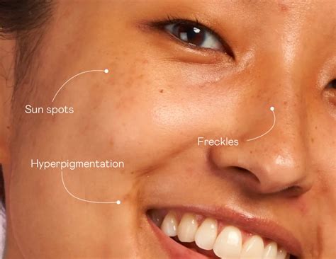 What Are Sunspots on the Skin and How Should I Treat Them?