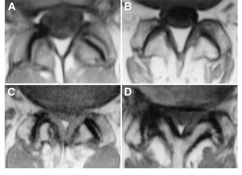 A-D Four grades of facet joint osteoarthritis on MRI (TR = 570 ms/TE ...
