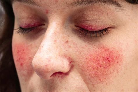 common   rosacea sanford dermatology