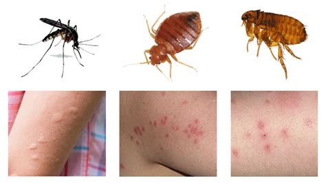 piqure de punaise de lit comment la reconnaitre