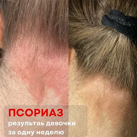 Псориаз - результат за одну неделю! | Академия здорового питания GEO | Дзен