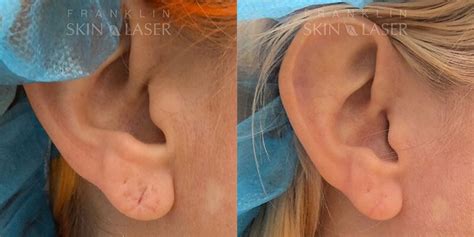 Earlobe Repair Before and Afters | Franklin Skin and Laser