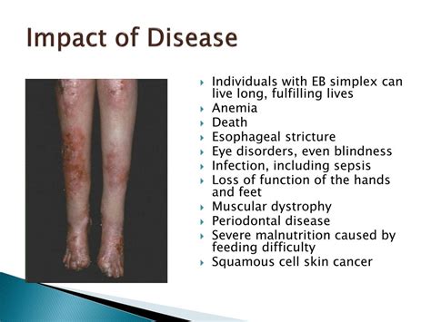 PPT - Epidermolysis bullosa simplex PowerPoint Presentation, free download - ID:2762520