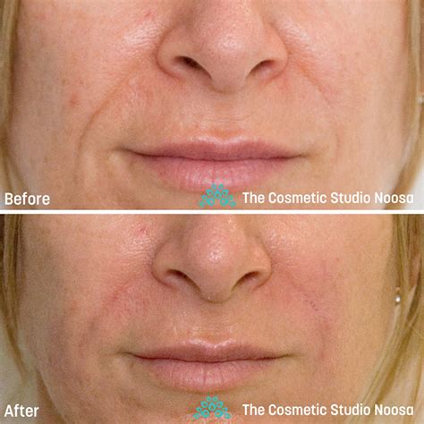 Nasolabial Fold Filler | The Cosmetic Studio Noosa