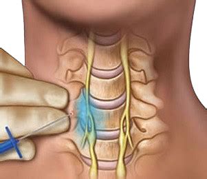 Stellate Ganglion Block - FAQ - Ashmore Osteopathic GroupAshmore ...