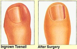 cost of ingrown toenail removal - zollinger-kemme