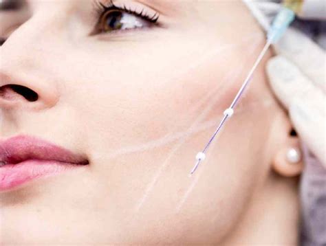 thread face lift aesthetics  varicose veins