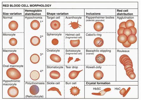 Medical Laboratory and Biomedical Science: Red Blood Cell Morphology Abnormalities