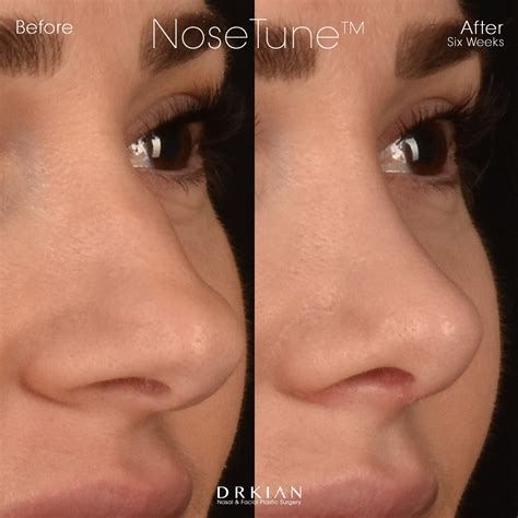 NoseTune Rhinoplasty — Dr. Kian