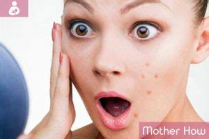 Pregnancy Acne: Causes, Prevention & Treatment - MotherHow