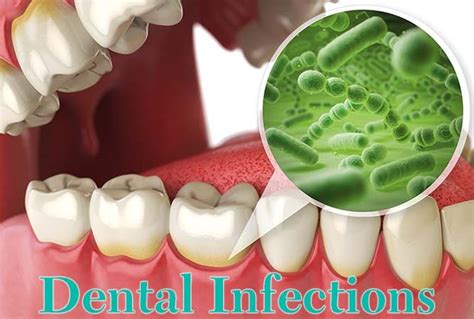 Peerless Info About How To Get Rid Of Tooth Infection - Policebaby25