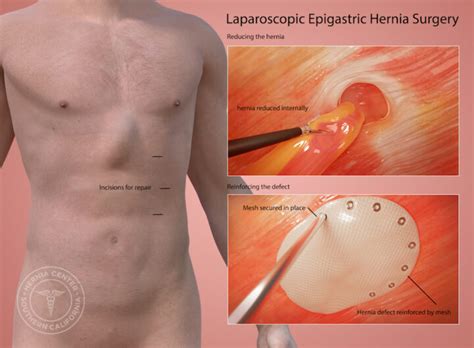 Epigastric Hernia Treatment Pasadena Los Angeles Orange County CA