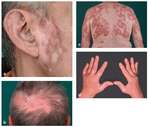 kriteria diagnosis sle systemic lupus erythematosus kedokteran