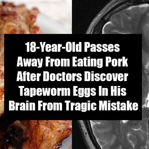 18-Year-Old Passes Away From Eating Pork After Doctors Discover Tapeworm Eggs In His Brain From ...