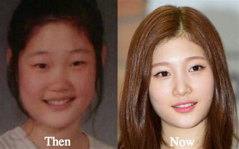 Korean Artist Plastic Surgery Before And After