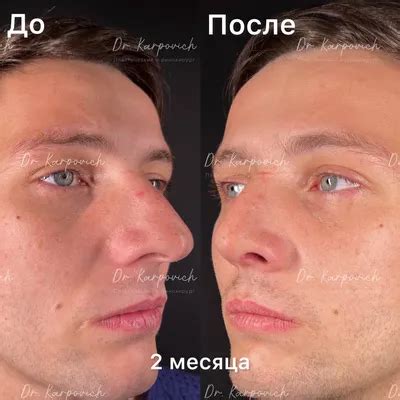 82+ Ринопластика широкого носа фото