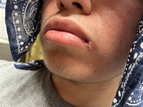 Cold Sores Vs Herpes Std