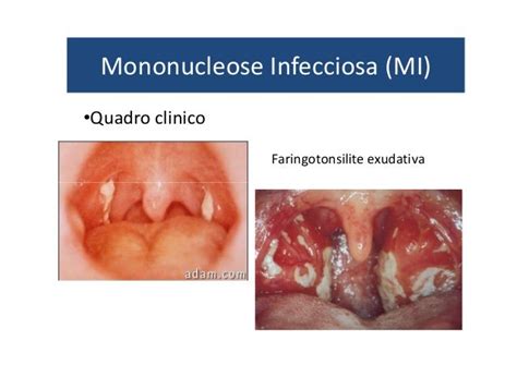 Mononucleose Quanto Tempo Dura - Mononucleose Infecciosa