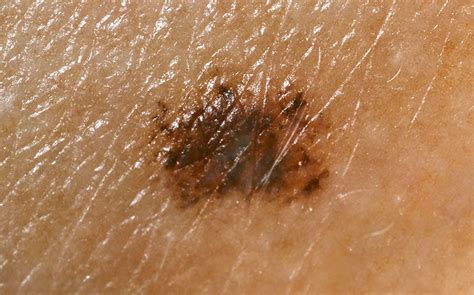 melanoma   skin cancer model dermatology pathology chart model