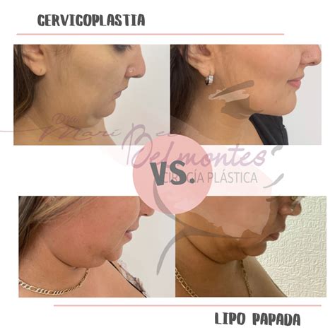 Cervicoplastia O Que É - CERVICOPLASTIA — Dra. Maribel Belmontes Castillo