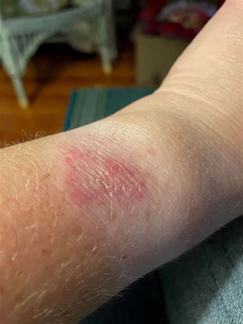 Why Do I Get A Rash After Wearing My Apple Watch ? - DeviceMAG