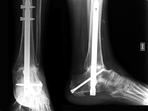 X-ray showing a combined ankle and subtalar arthrodesis by ...