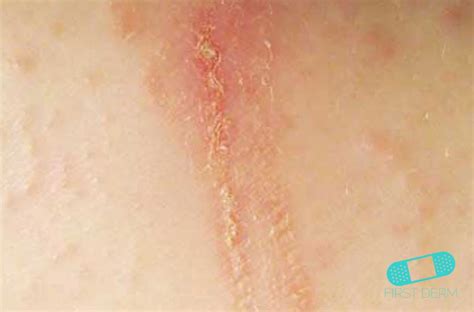 how to know if i have contact dermatitis