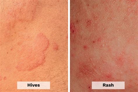 itchy hives  night  keith herrera blog