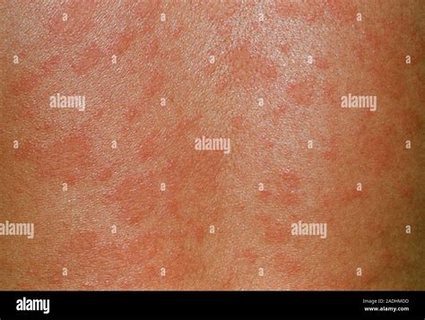 herald patch rash