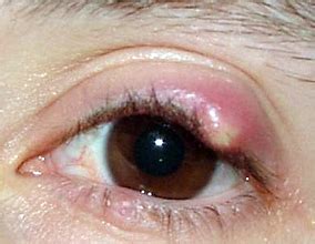 Chalazion | Jonathan Dutton Ocul